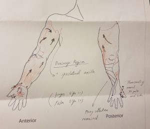 20181016_212821_resized-300x257 ICG Imaging - The New Way To Diagnose Lymphoedema